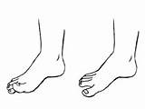 Pictures of Intrinsic Foot Muscle Exercises