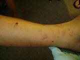 Bed Bug Treatment Manchester Pictures