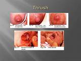 Nipple Thrush Home Remedies Images