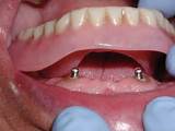 Implant Denture Repair Pictures
