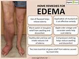 Edema Home Remedies Pictures