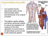 Pictures of Intra Aortic Balloon Pump