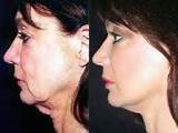 Muscle Exercises For Jowls Pictures