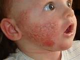 Infant Eczema Home Remedies Images
