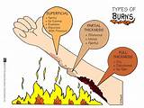 The Degrees Of Burns Pictures