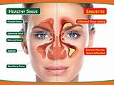 Infected Sinuses Home Remedies