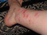 Treatment For Bed Bugs On Skin Pictures