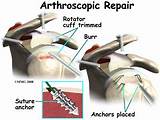 Post Rotator Cuff Surgery Recovery Images