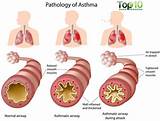 Top Asthma Medications Photos