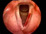 Vocal Cord Nodules Surgery Recovery Time Images