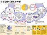 Colorectal Cancer Treatment Options Images