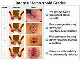 What Will A Doctor Do For Hemorrhoids Images