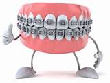 Pictures of Orthodontic Insurance Coverage For Adults