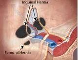 Inguinal Hernia Muscle Strengthening Photos