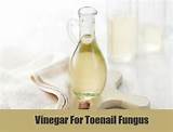 Images of Vinegar Home Remedies For Toe Fungus