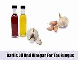 Photos of Vinegar Home Remedies For Toe Fungus