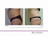 Pictures of Surgical Cellulite Treatment