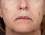 Images of Home Remedies For Age Spots On Face And Hands