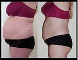 What Is Strawberry Laser Lipo Treatment Images