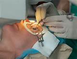 Medicaid Lasik Eye Surgery