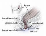 Pictures of Hemorrhoid Removal Surgery Recovery