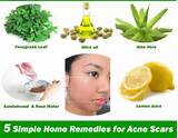 Acne Scar Home Remedies Fast Pictures