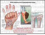 Photos of Wrist Tendon Injury Recovery Time