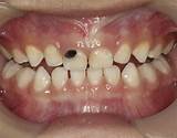 Pictures of Silver Treatment For Cavities