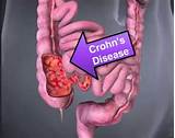 Pictures of How To Control Crohn S Disease