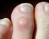 Best Treatment For Corns And Calluses Photos