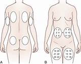 The Parenteral Route Of Administering Medications Is Used Pictures