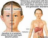 Jaundice Symptoms And Treatment Images