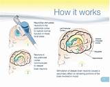 Electric Stimulation Therapy Side Effects Pictures