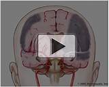 Anoxic Brain Damage Recovery Images