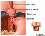 Images of Can Heartburn Cause Abdominal Pain