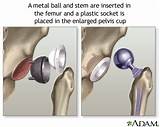 Images of Partial Hip Replacement Recovery Time Elderly