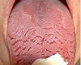 Tongue Cracks Home Remedies