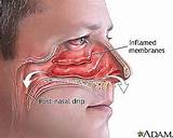 Home Remedies For Swollen Nasal Turbinates