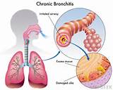 Pictures of Breathing Exercises Chronic Bronchitis