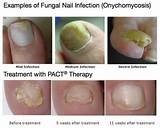 Severe Foot Fungus Treatment Pictures