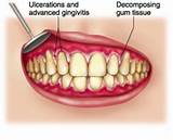 Gum Inflammation Medication Pictures