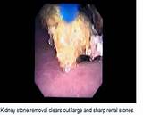 Laser Kidney Stone Removal Recovery Time Images