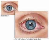 Eye Strain Home Remedies