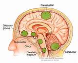 Pictures of Frontal Lobe Tumor Treatment