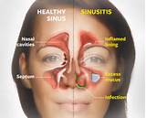 Home Remedies For Swollen Nasal Turbinates Pictures