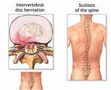 Pictures of What Is The Recovery Time For Cervical Spinal Fusions