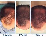 Prp Hair Treatment Cost Photos