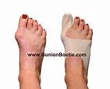 Bunion Scar Treatment Pictures