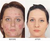 Side Effects Of Tetracycline For Acne Images