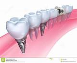 Dental Implants On Payment Plan